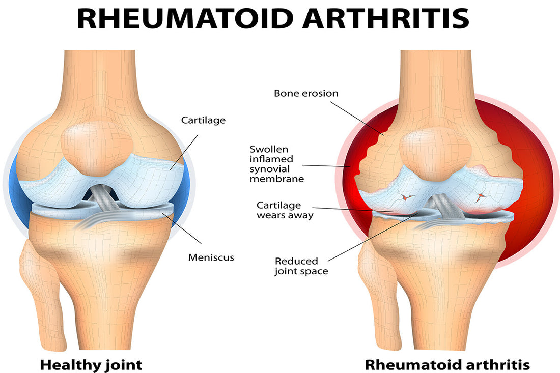 Painful Joints