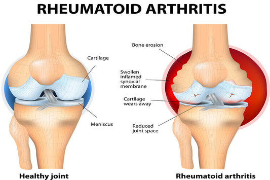 Painful Joints