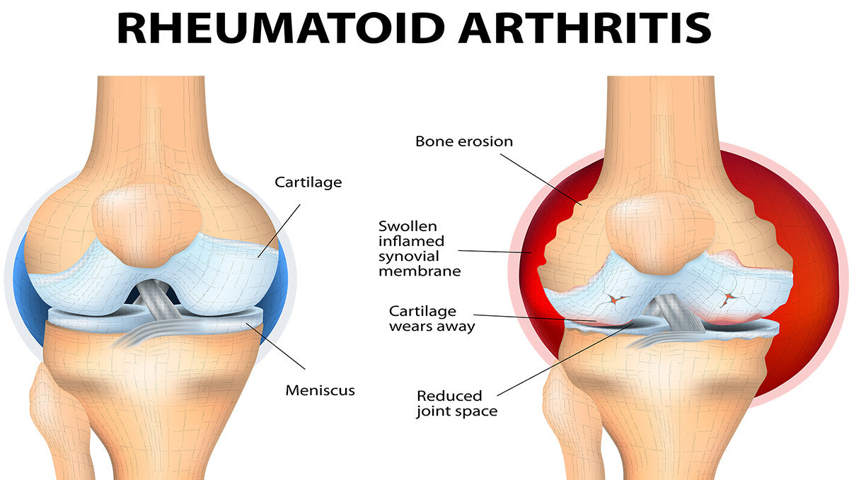 Salmon Collagen: Amazing Supplement to Give Relief from Painful Joints